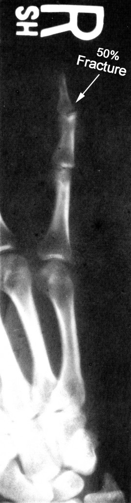 x-ray-broken-finger